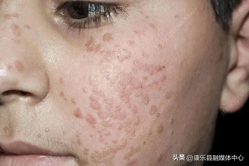 身上長了HPV，我們該如何面對與處理